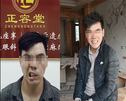 正容堂面瘫患者比对