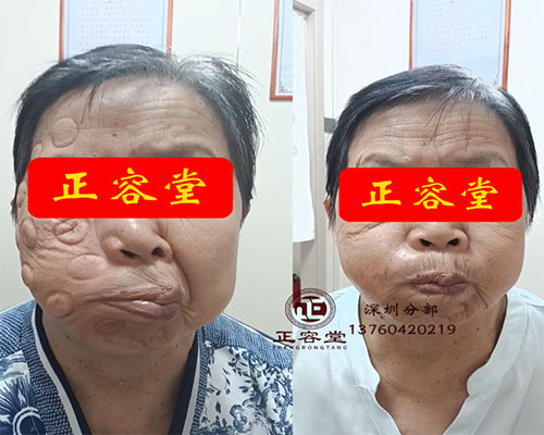 老年人病毒性面瘫需要多久能恢复正常