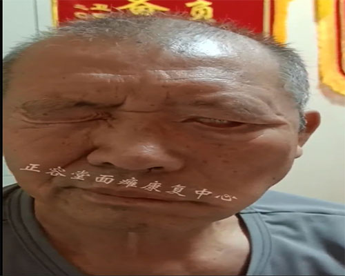 面瘫超过三个月还能治愈吗