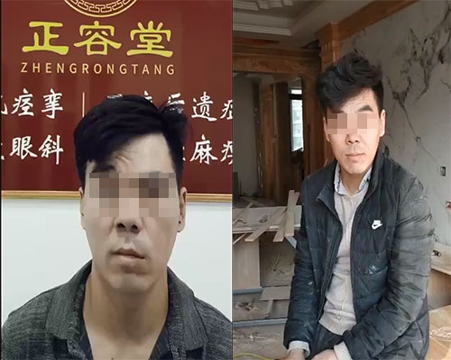 正容堂面瘫患者比对