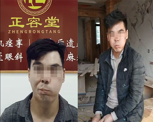 陈先生面瘫治疗前后鼓气对比图