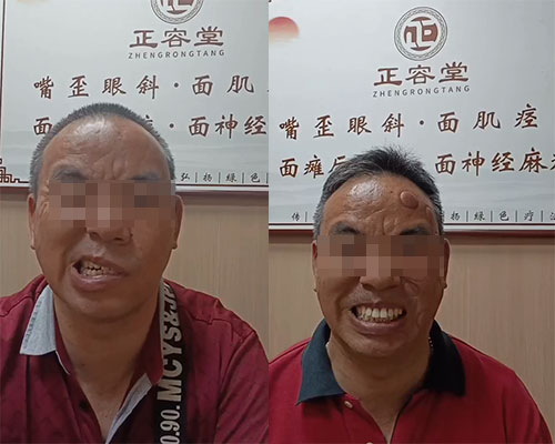 广州面瘫患者张先生的面瘫治疗历程