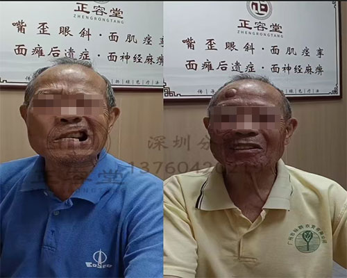 深圳罗湖李大叔面瘫治疗的曲折之路