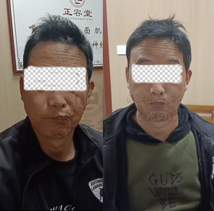 深圳邢先生面瘫治疗的历程