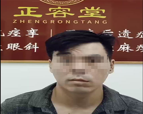 面瘫后遗症用这些方法治疗不可行