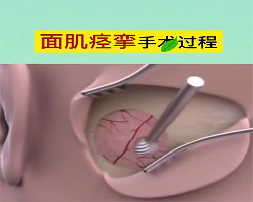 面肌痉挛可以做手术治疗吗