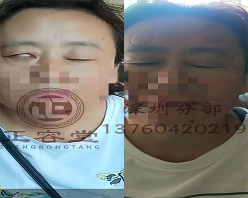 深圳面瘫专科哪家强？正容堂专业诊疗助您重拾自信笑容