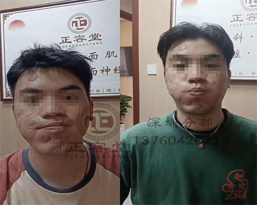 深圳面瘫治疗案例之李先生的面瘫经历