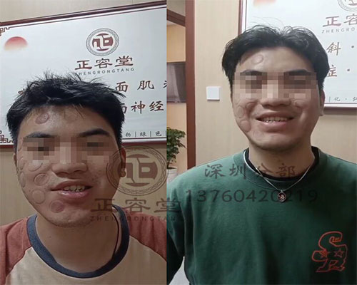 深圳面瘫患者李先生治疗前后呲牙对比图
