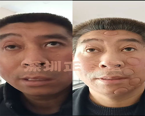深圳龙岗面瘫患者韩先生的面瘫治疗前后对比图