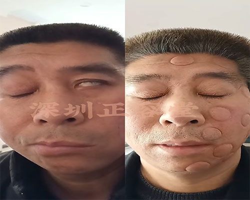 深圳面瘫患者韩先生治疗前后闭眼对比图