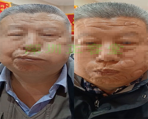 深圳罗湖面瘫患者李先生面瘫治疗前后对比图