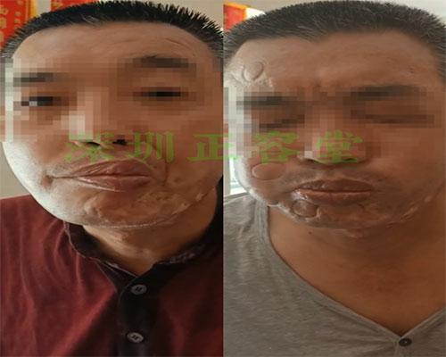深圳面瘫患者唐先生面瘫治疗前后对比图