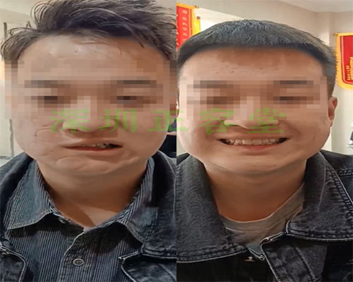 小刘同学在深圳面瘫专科治疗前后的对比图