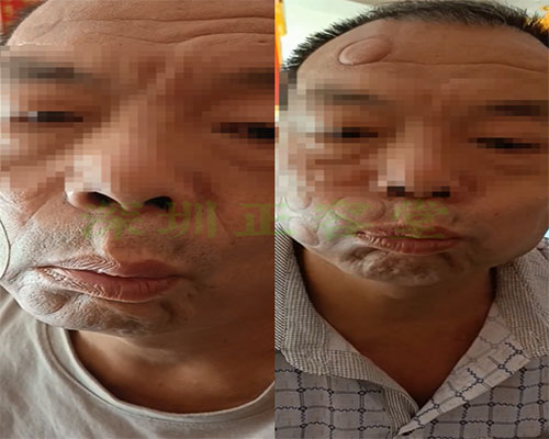 王先生在深圳面瘫专科治疗面瘫前后视频对比图