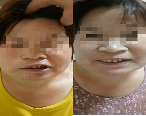 深圳面瘫患者治疗前后呲牙对比图