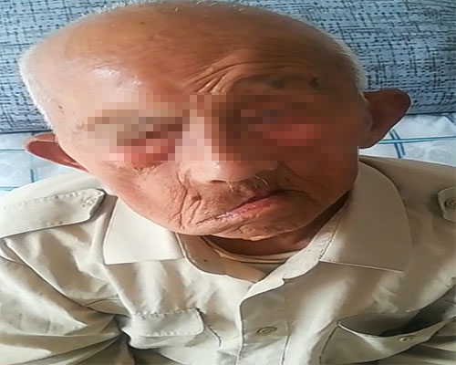 面瘫后遗症图片.jpg
