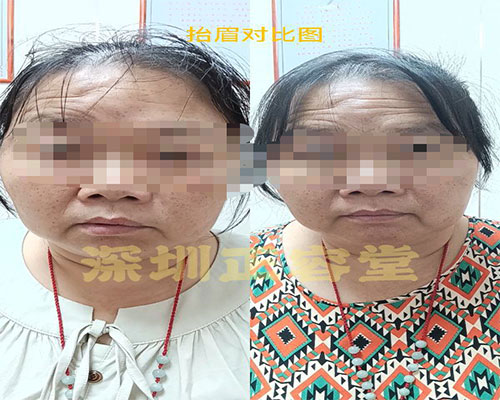 深圳面瘫专科为杨女士去除面瘫折磨