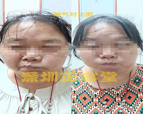 面瘫患者鼓气对比图.jpg