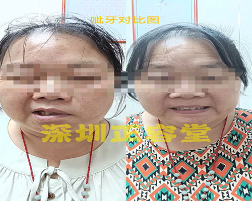 面瘫患者呲牙对比图.jpg