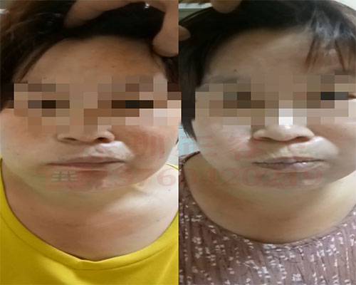 周女士在深圳面瘫专科治疗面瘫前后对比图