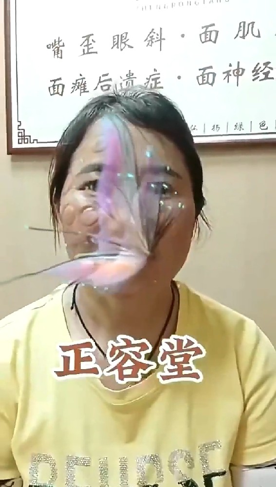 面肌痉挛除了做手术还有其他治疗方法吗