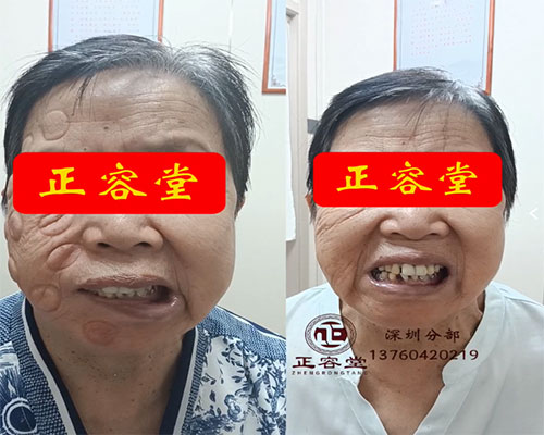 面瘫患者治疗前后呲牙对比图