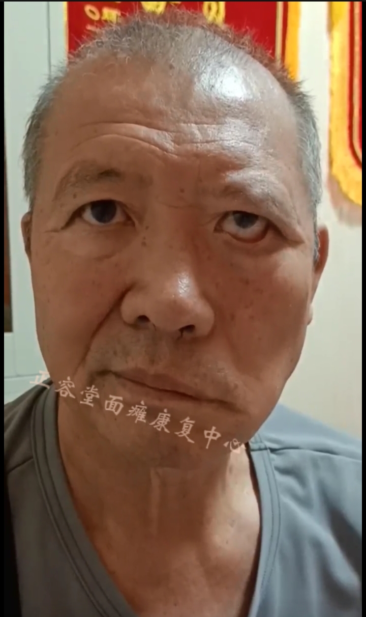 面瘫后遗症患者图片