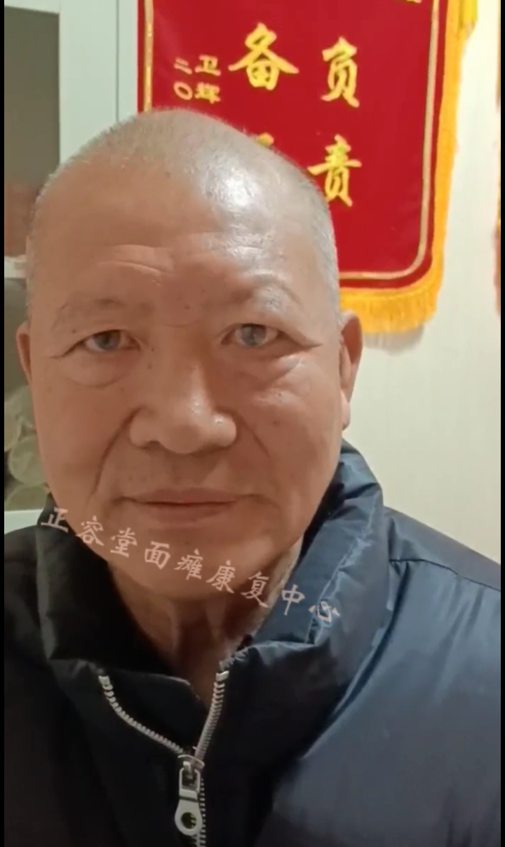 面瘫后遗症治愈图片