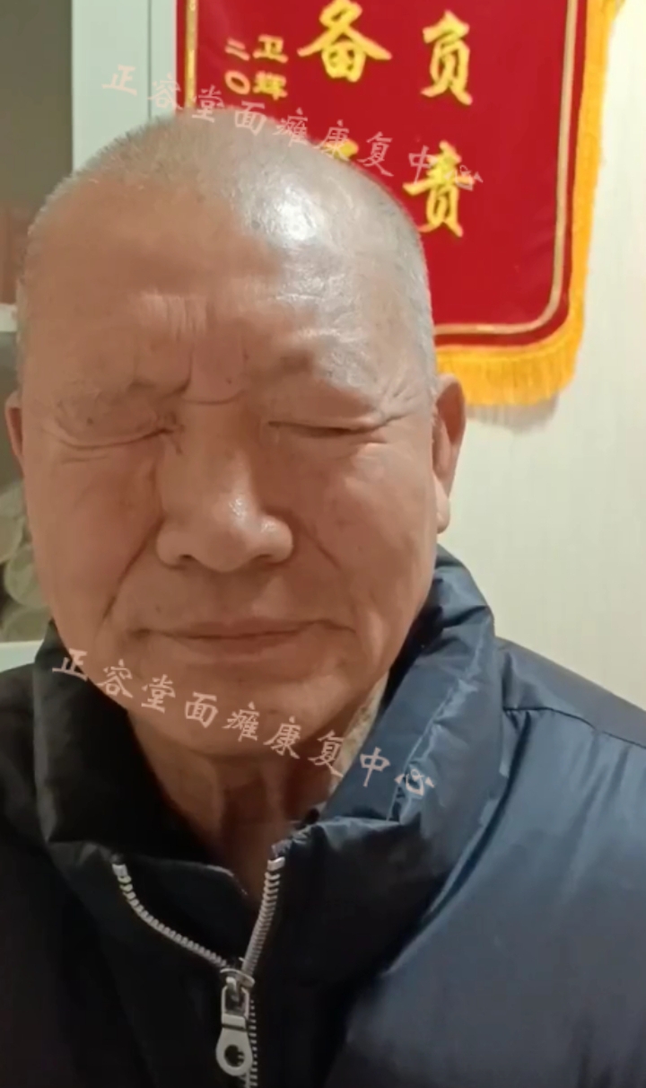 面瘫后遗症治愈图片