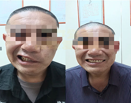 深圳外伤面瘫患者的康复之路